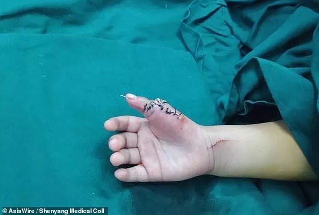 طفلة لديها 14 إصبع بعد العلاج