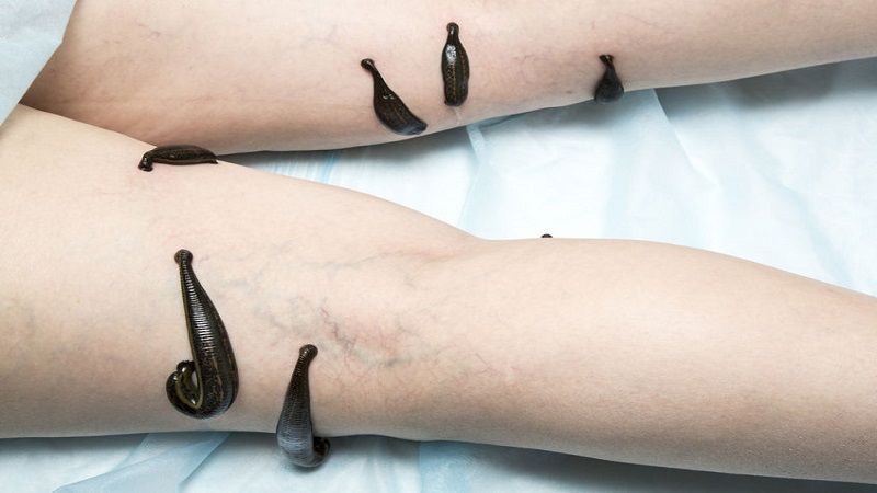 Leech-Therapy-Medicinal-Leeches-for-thrombophlebitis