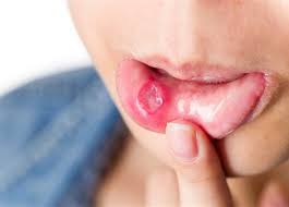 علاج قرح الفم