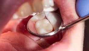 لو حشيت أسنانك ولسه فى وجع قد تكون لديك حساسية بعد الحشو اليوم السابع