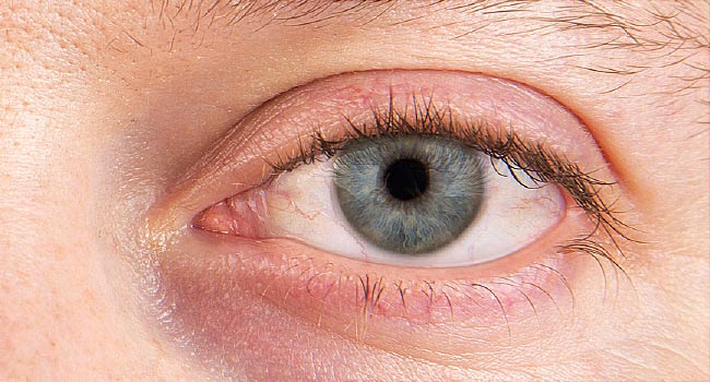 اعراض جفاف العين 2