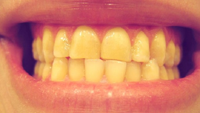 علاج اصفرار الاسنان
