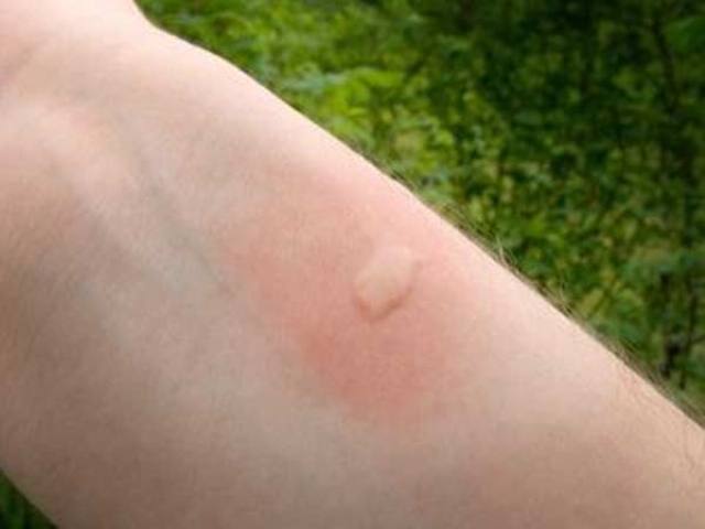 how-to-reduce-the-symptoms-arising-from-the-bite-of-a-mosquito