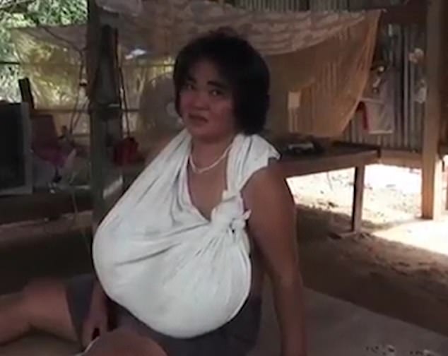 امرأة تايلاندية ثديها لا يتوقف عن النمو