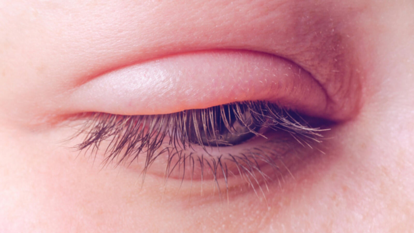Causes of Eyelid Eyelid Causes of Eyelid Eyelid