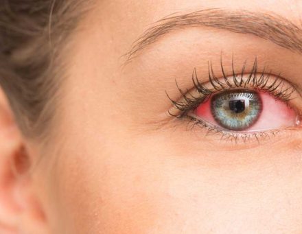 احمرار العينين (3)