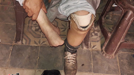 جوزيف مصاب بقطع ساق واجزاء من قدمه