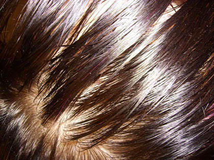 oily scalp and hair  2