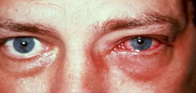 كيفية الوقاية من التهاب العين