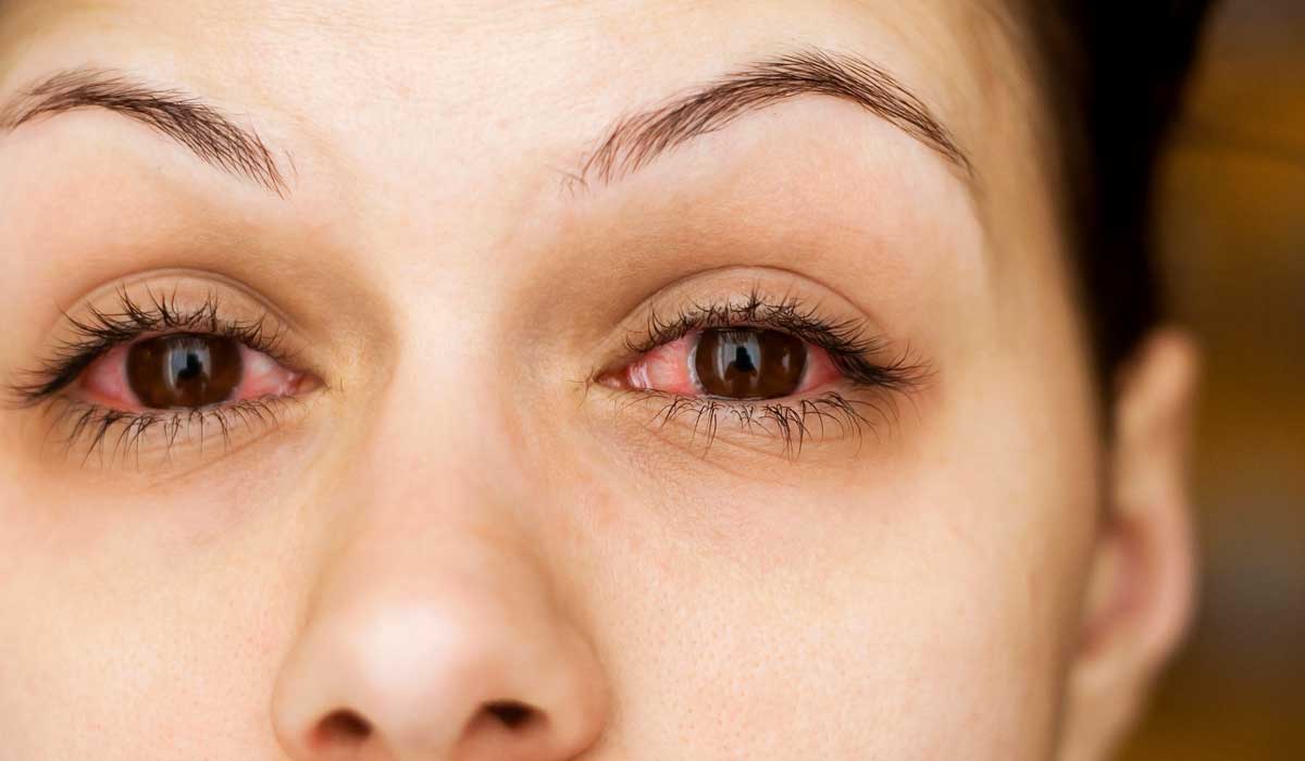 أسباب التهاب العين