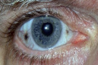 تأثير البول الاسود على العين