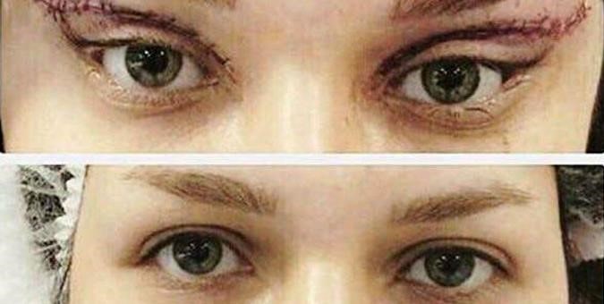 عمليات تجميل لتحويل عيون النساء لعين  (1)