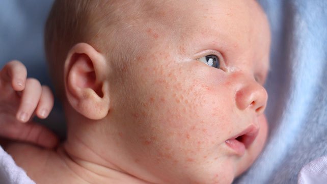 infant_acne-642x361-slide2