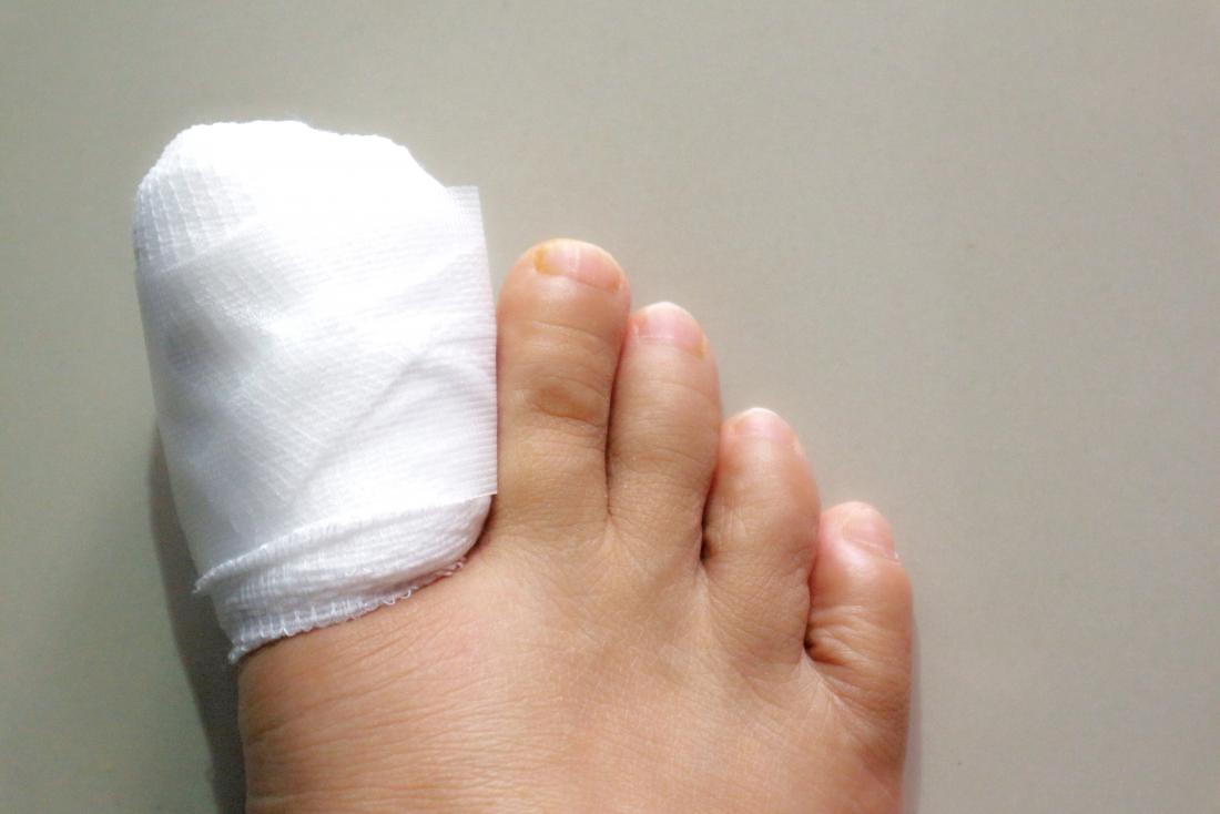 a-toe-in-a-bandage-recovering-from-ingrown-toenail-surgery