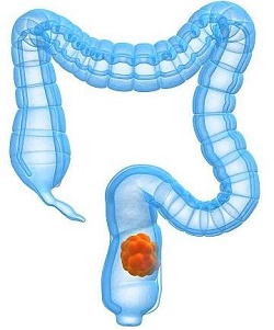 سرطان المستقيم سرطان المستقيم
