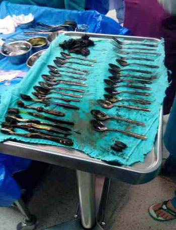 الأدوات-التي-تم-استخراجها-من-معدة-المريض-(2)