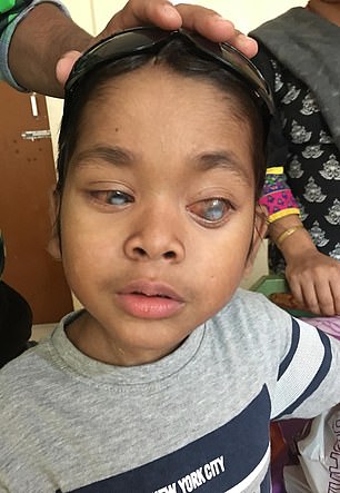 الطفل المصاب بسرطان بالعين