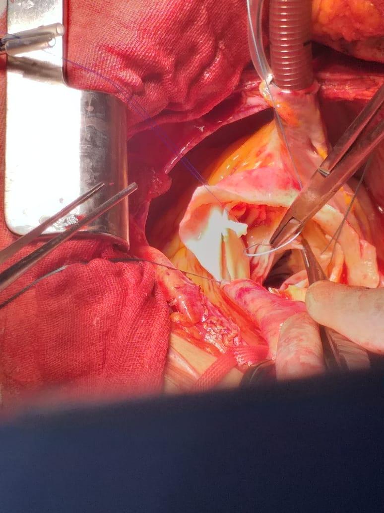 جراحة انشطار فى الشريان الاورطى بمستشفى القلب بأسيوط (3)