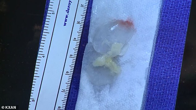 قصة رجل عاش بصداع مزمن لمدة 10 سنوات والسر دودة فى المخ فيديو اليوم السابع
