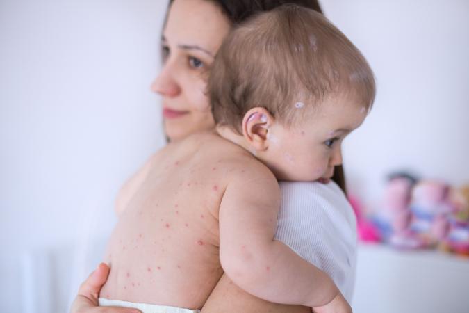 222534-675x450-baby-with-chicken-pox