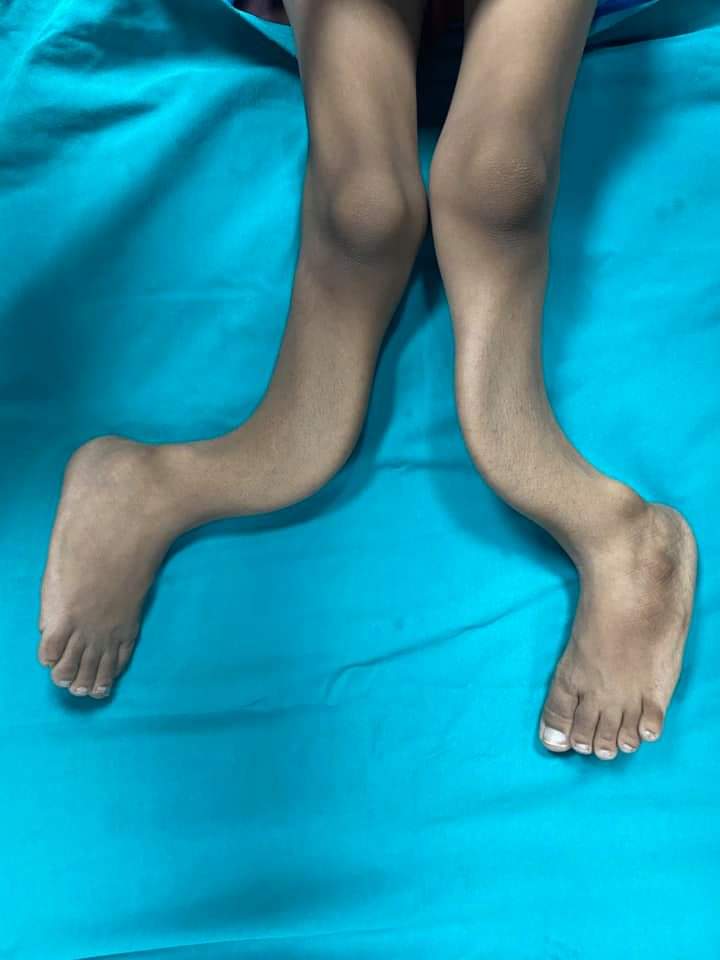 تقويم إعوجاج ساقي طفل منعه من المشي (2)
