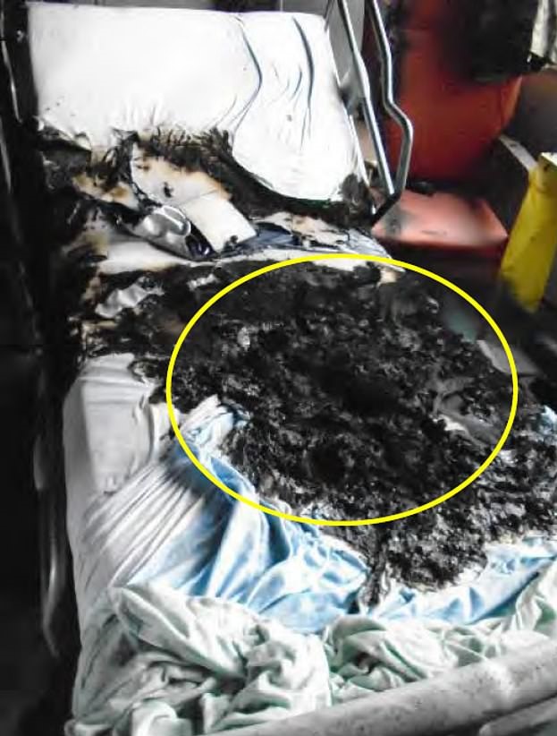 سرير المريض بعد حرقه بسبب تدخينه السجائر