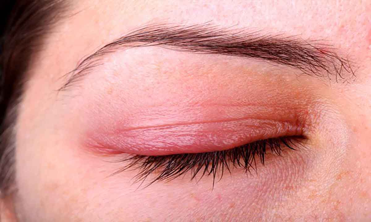 كيفية-علاج-التهاب-الجفن-في-العين