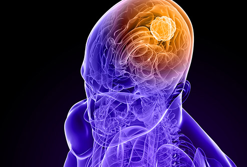 493ss_getty_rf_brain_cancer_illustration