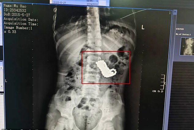 الأشعة السينية تظهر حبات المغناطيس فى بطن المريض