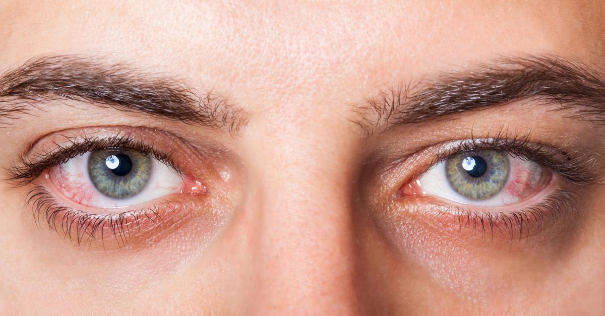 اعراض جفاف العين