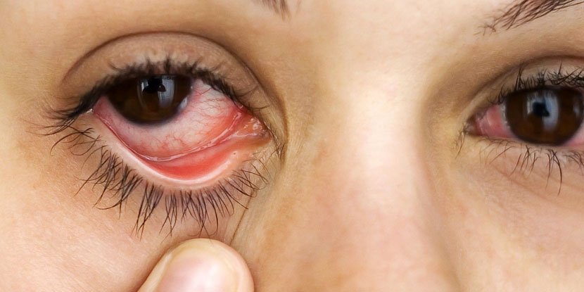اعراض جفاف العين 1