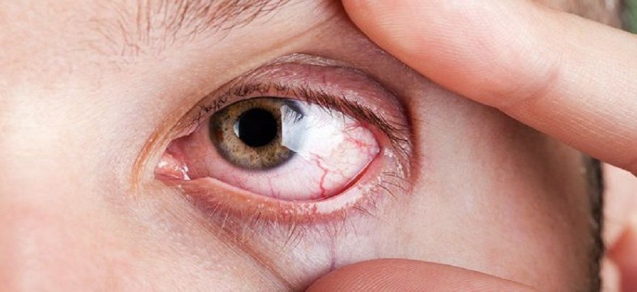 اعراض جفاف العين 3