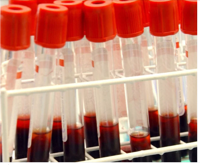 اختبار دم يكتشف الزهايمر قبل الاصابة ب 4 سنوات