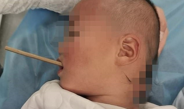 طفل ينجو من الموت بعد اختراق عصا طعام حلقه بطول 20 سم (1)