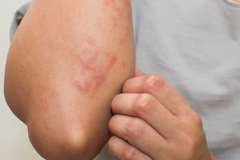 اعراض حساسية الجلد حسب نوعها من الإكزيما للأرتكاريا اليوم السابع