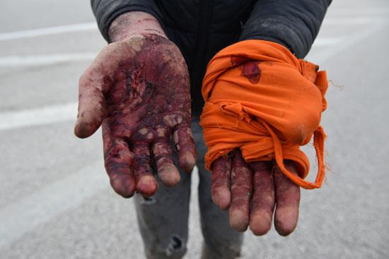مهاجر من أفغانستان يظهر يديه التي أصيبت في محاولة لعبوره من تركيا إلى اليونان