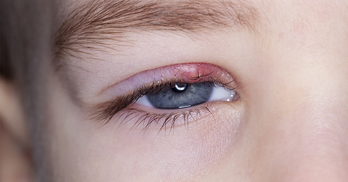 علاج دمل العين 2