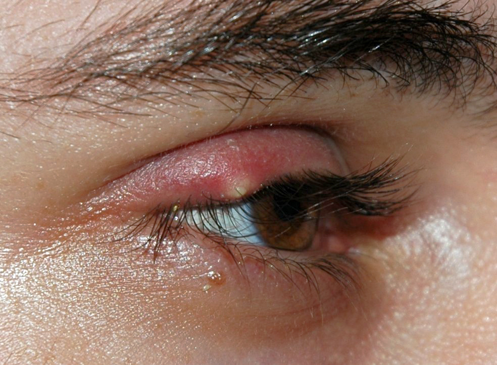 علاج دمل العين