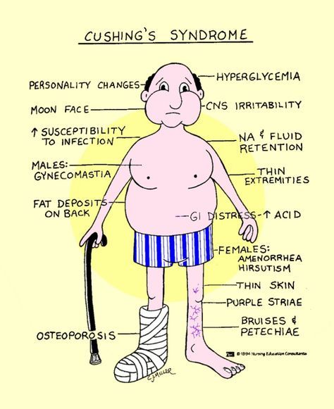 رسم يوضح اعراض متلازمة كوشينج