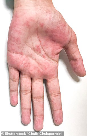 27696120-8260399-Toxic_shock_syndrome_may_also_cause_rashes_but_it_s_not_clear_if-a-1_1587998224955