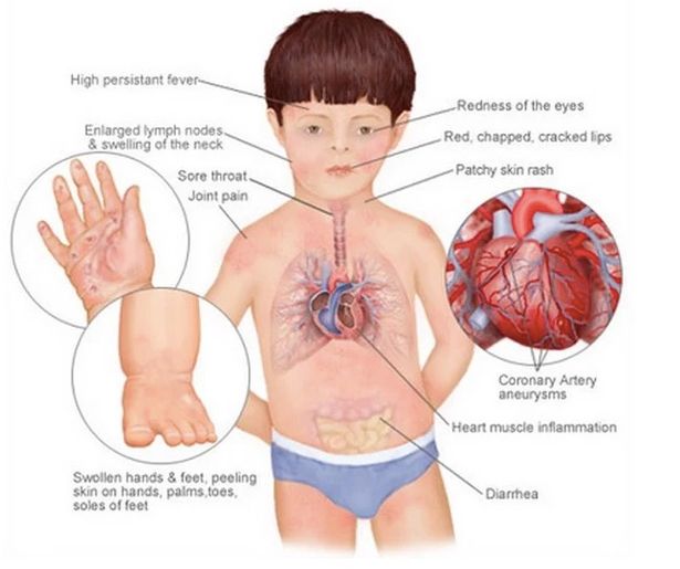 اعراض التهاب فى الاطفال