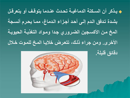 السكتة الدماغية (3)