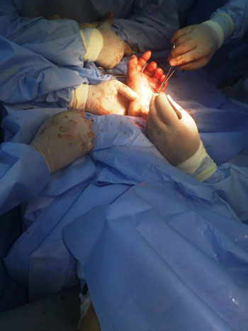 الفريق الطبى أثناء إجراءة عملية أعادة اليد المبتور