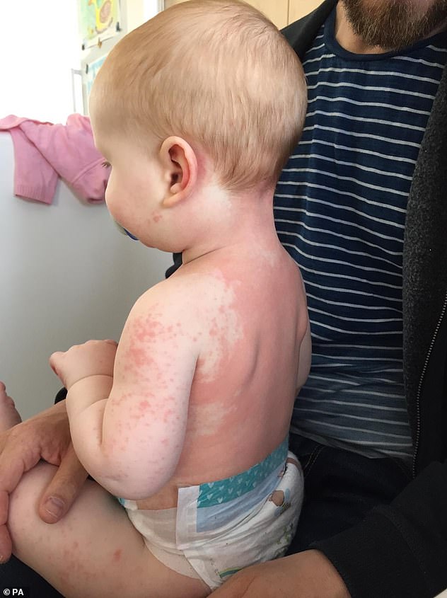 28571326-8348265-The_eight_month_old_had_rashes_and_a_high_temperature_both_sympt-a-2_1590160491733