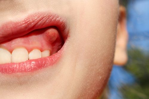 اعراض خراج الاسنان 3