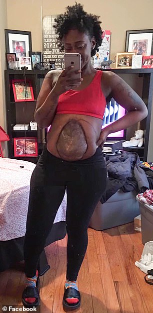 تظهر الصورة الامعاء خارج البطن تظهر الصورة الامعاء خارج البطن