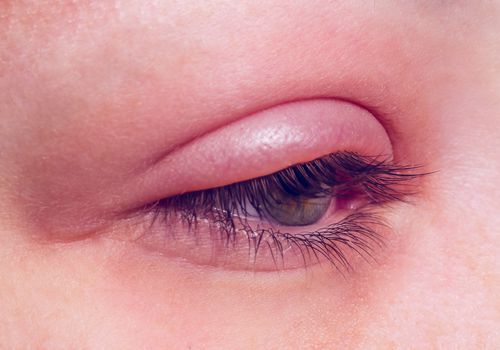 اسباب التهاب جفن العين