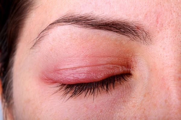 اسباب التهاب جفن العين 1