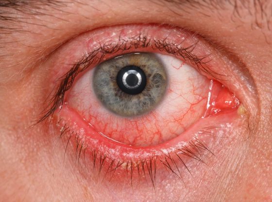اسباب التهاب جفن العين 3