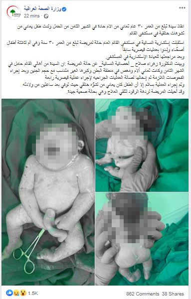 صور صادمة لولادة طفل يعانى من تشوهات خلقية فى العراق (3)